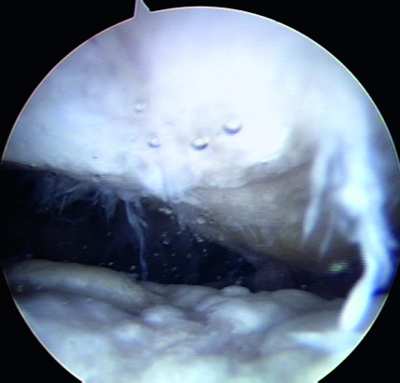 Arthrose. Blick durch die Kamera in das Gelenk.