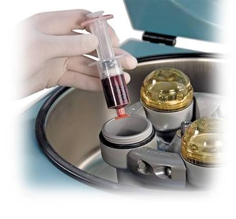 Eigenbluttherapie ACP