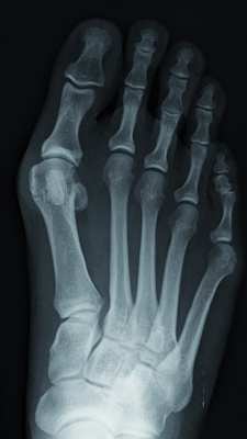 Hallux valgus.