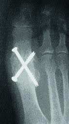 Arthrodese des Großzehengrundgelenks.