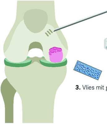Knorpeltransplantation mit Vlies.