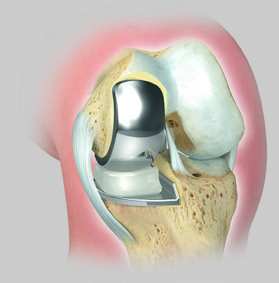 Schlittenimplantat.